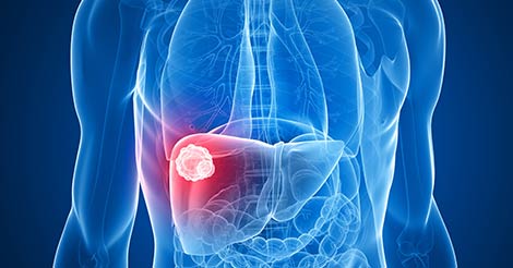 Liver Cancer - Overview