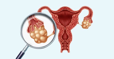 Ovarian Cancer - Overview